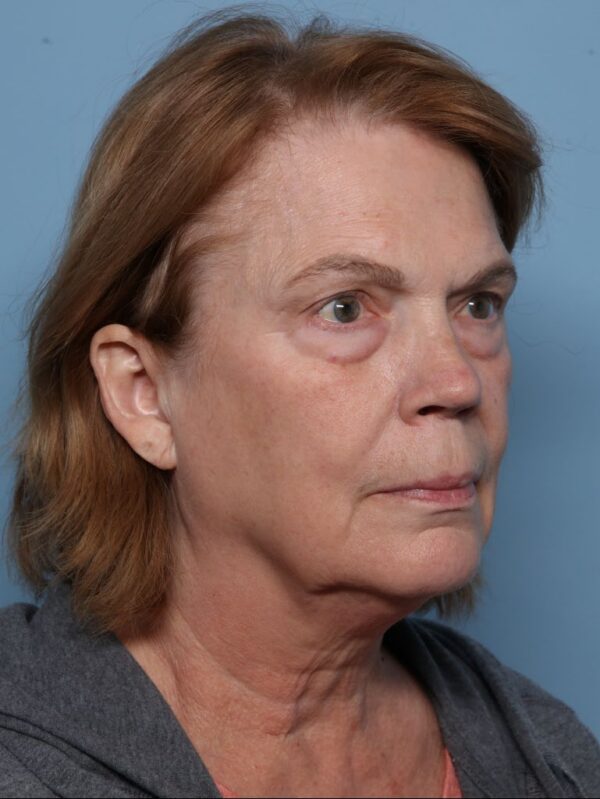 Lower Blepharoplasty