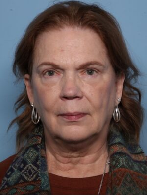 Lower Blepharoplasty