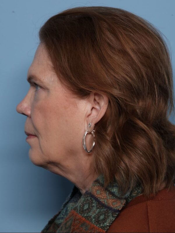 Lower Blepharoplasty