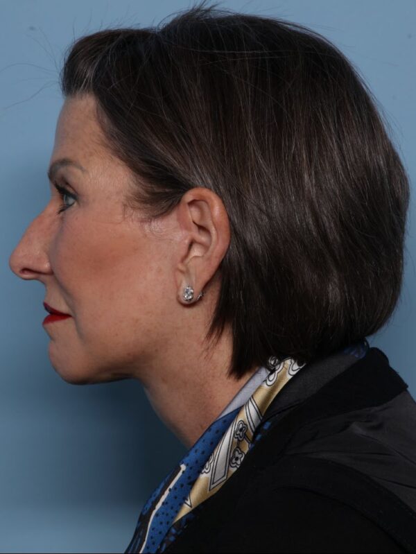 Deep Necklift