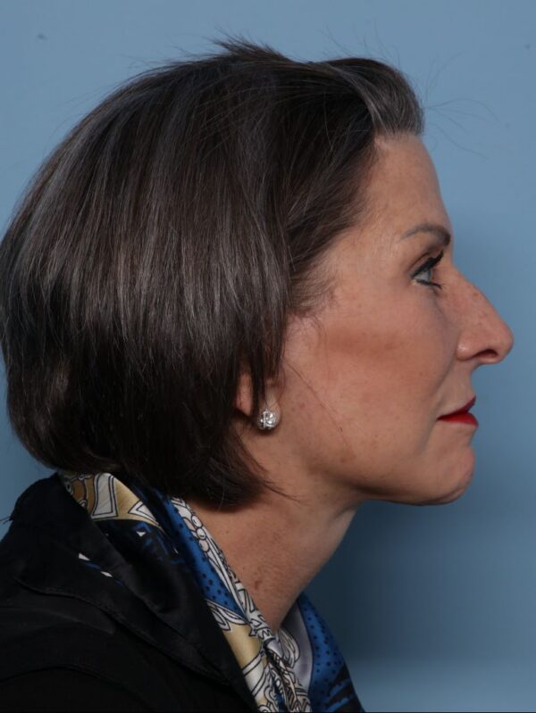 Deep Necklift