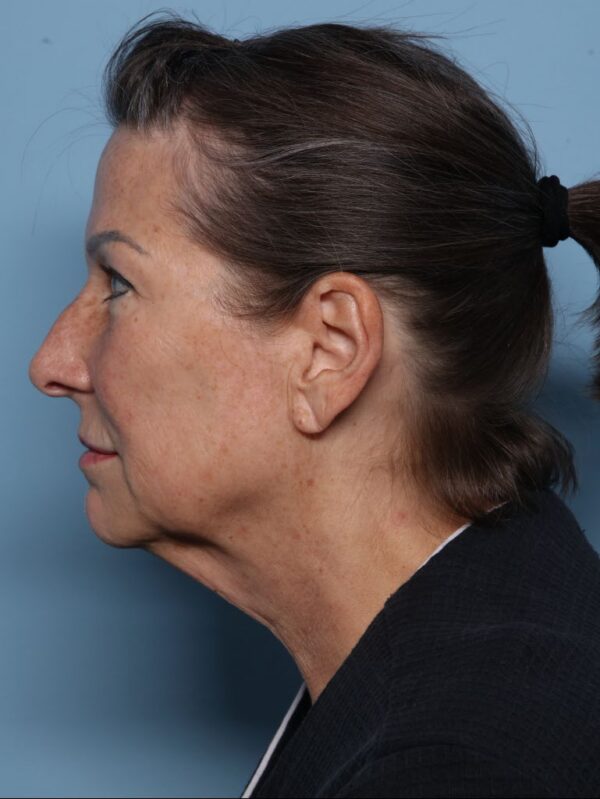 Deep Necklift
