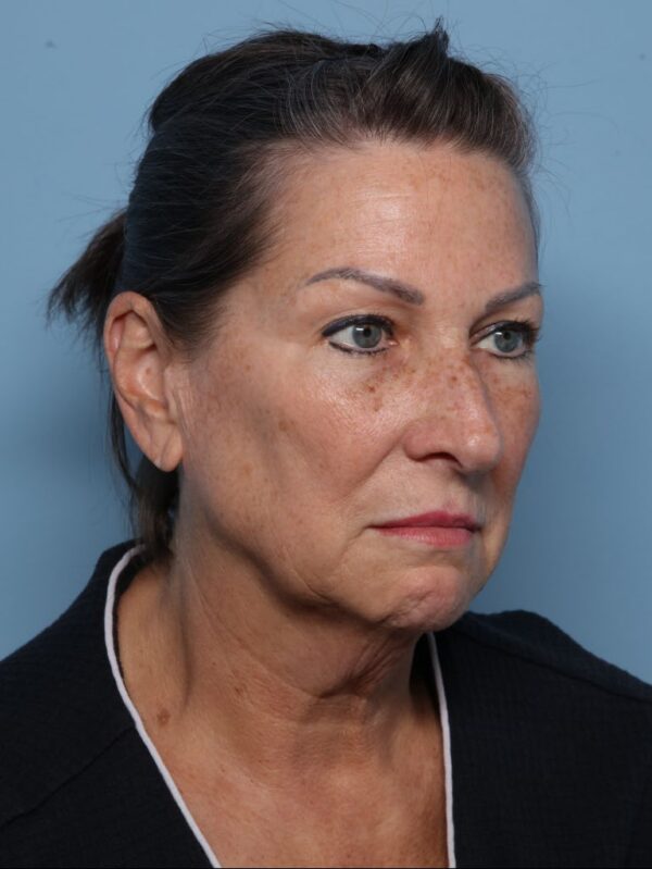Deep Necklift