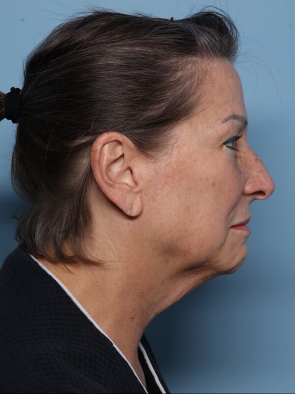 Deep Necklift