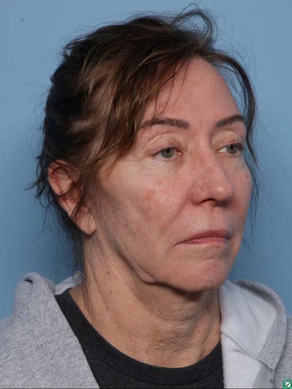 Facelift