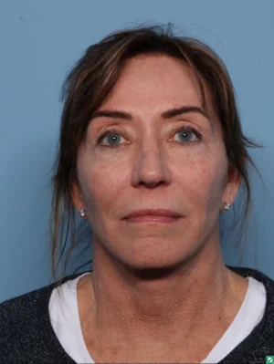 Facelift