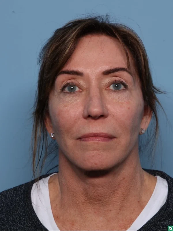 Facelift