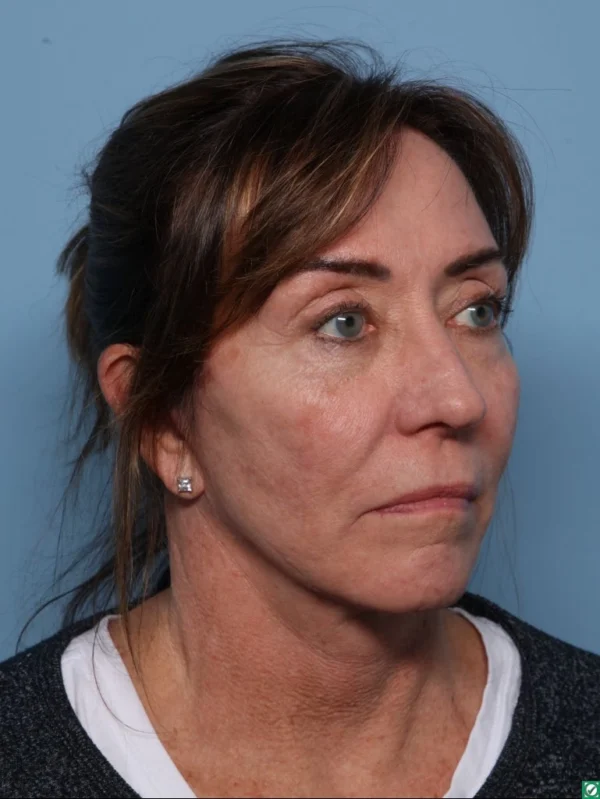 Facelift