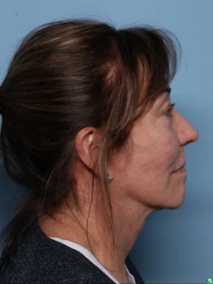 Facelift