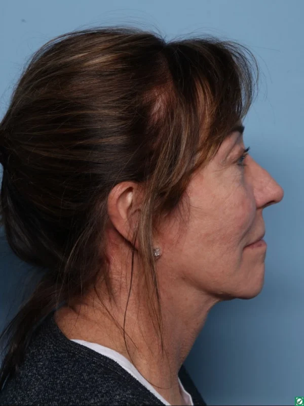 Facelift