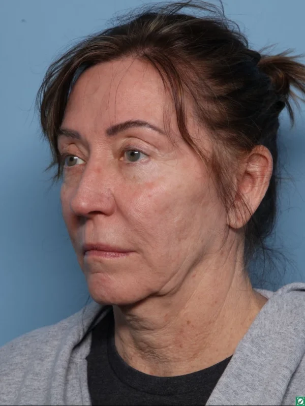 Facelift
