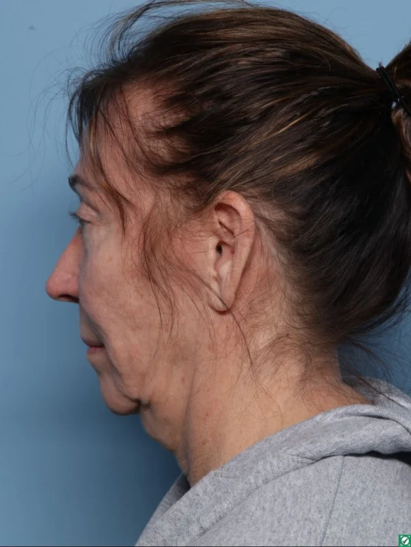 Facelift