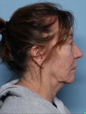 Facelift