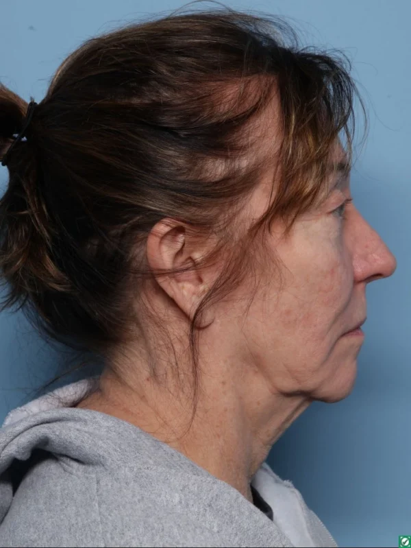Facelift