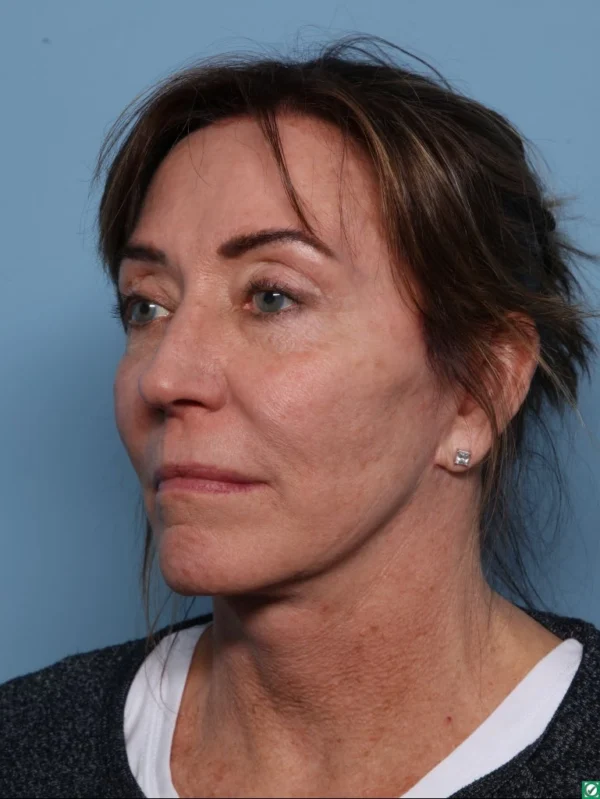 Facelift