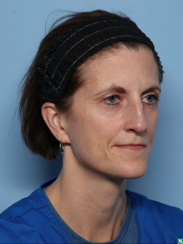 Rhinoplasty