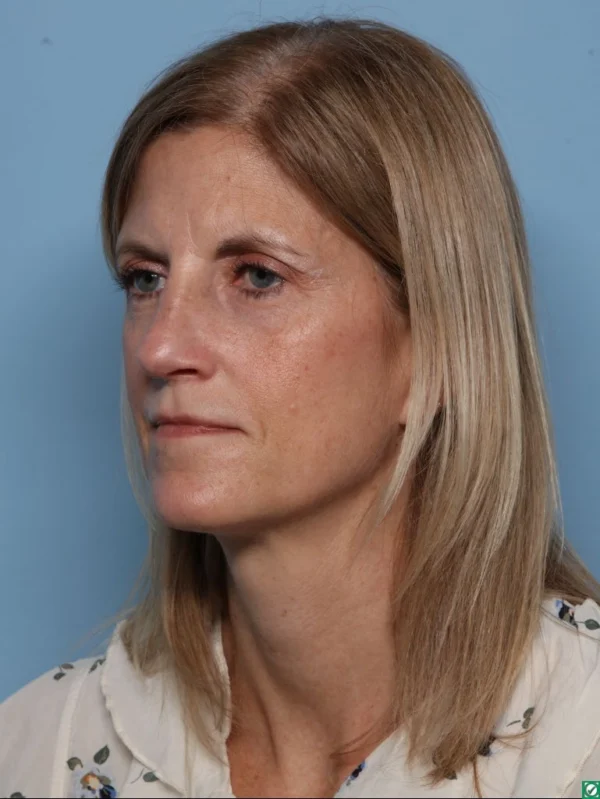 Rhinoplasty