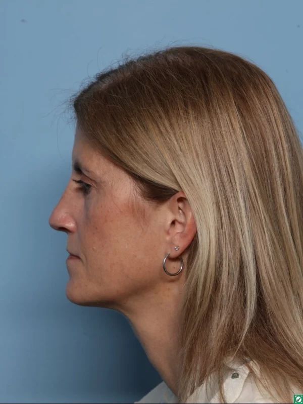 Rhinoplasty