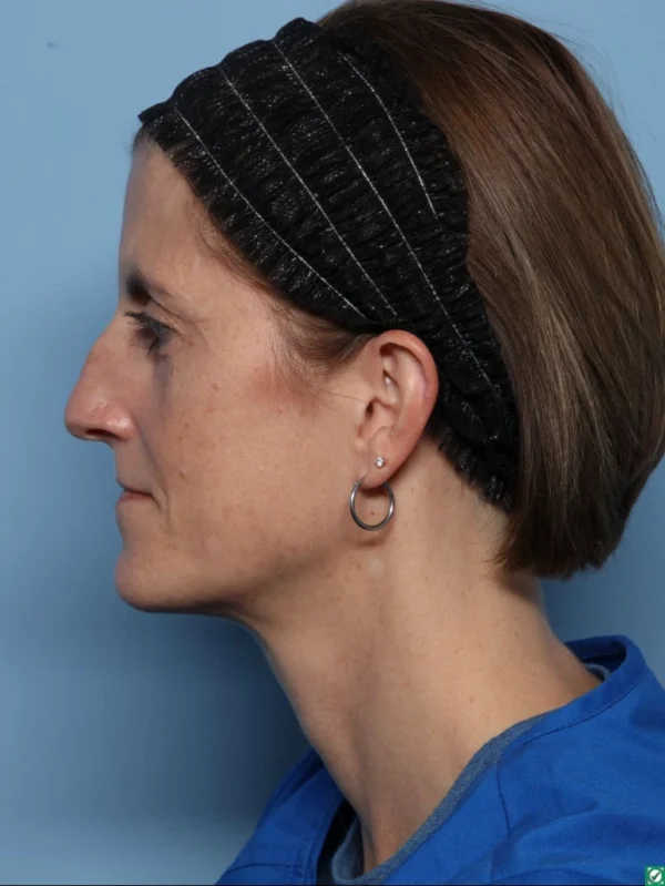 Rhinoplasty