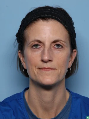 Rhinoplasty