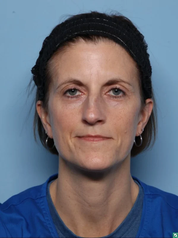 Rhinoplasty
