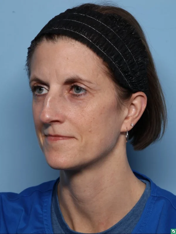 Rhinoplasty