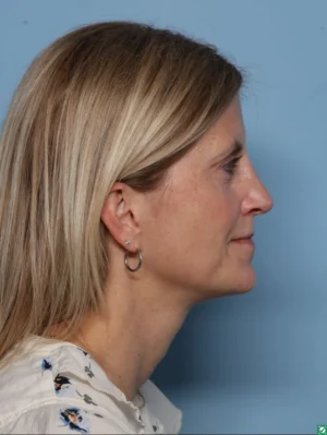 Rhinoplasty