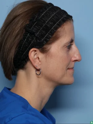 Rhinoplasty