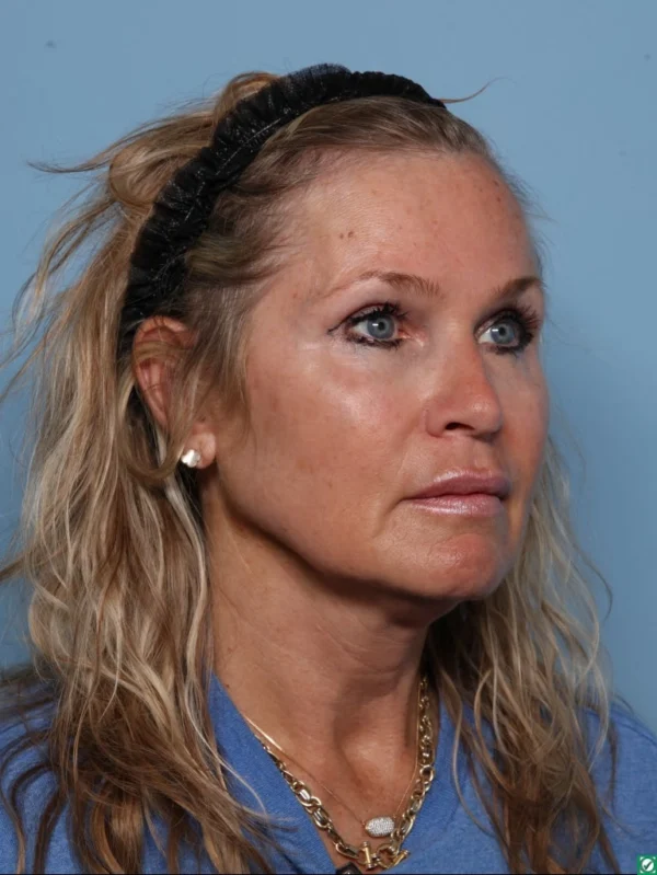 Facelift
