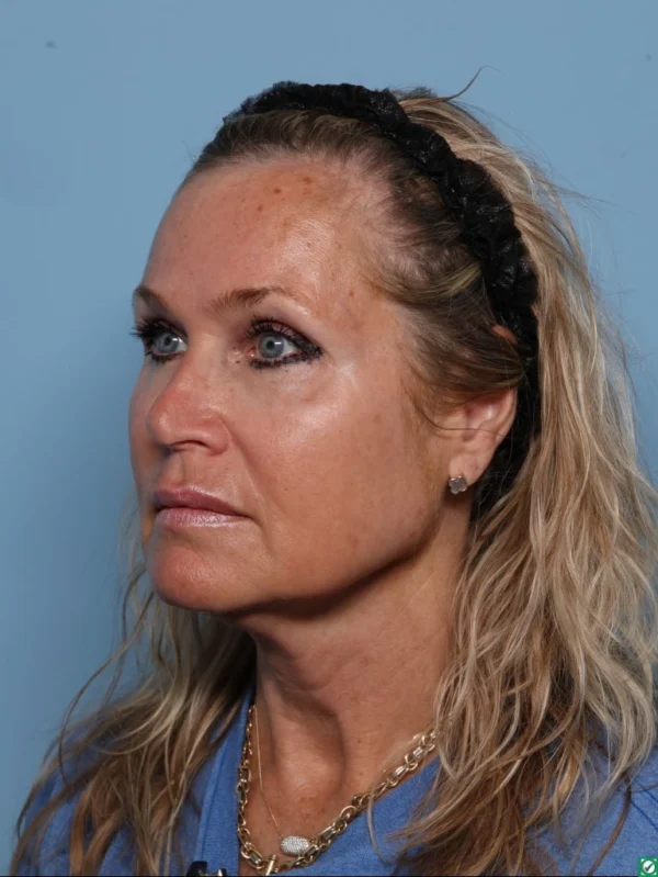 Facelift