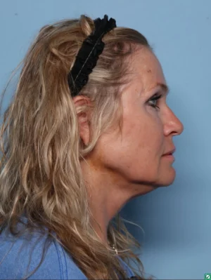Facelift
