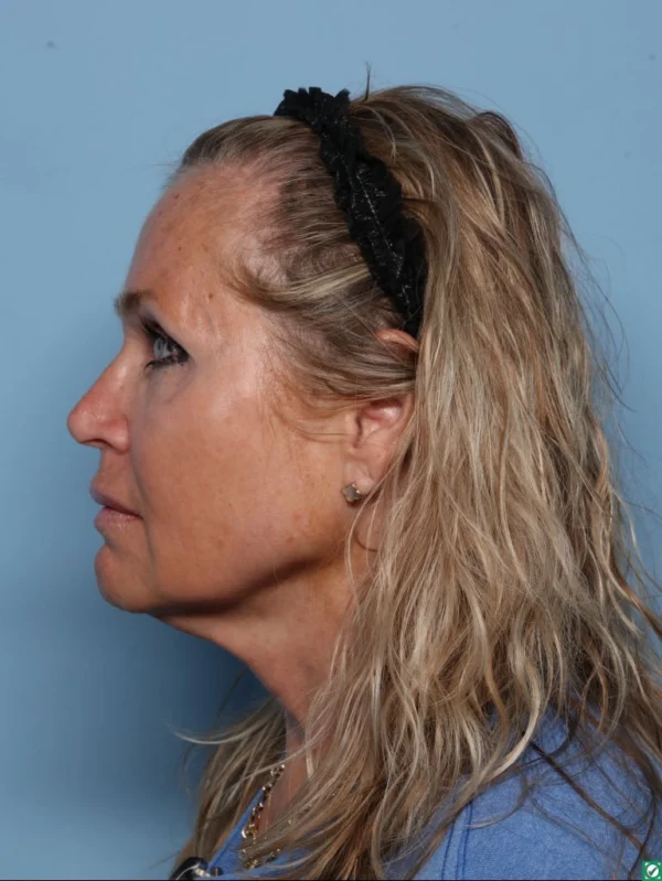 Facelift