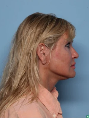 Facelift