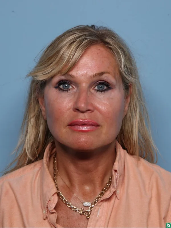 Facelift
