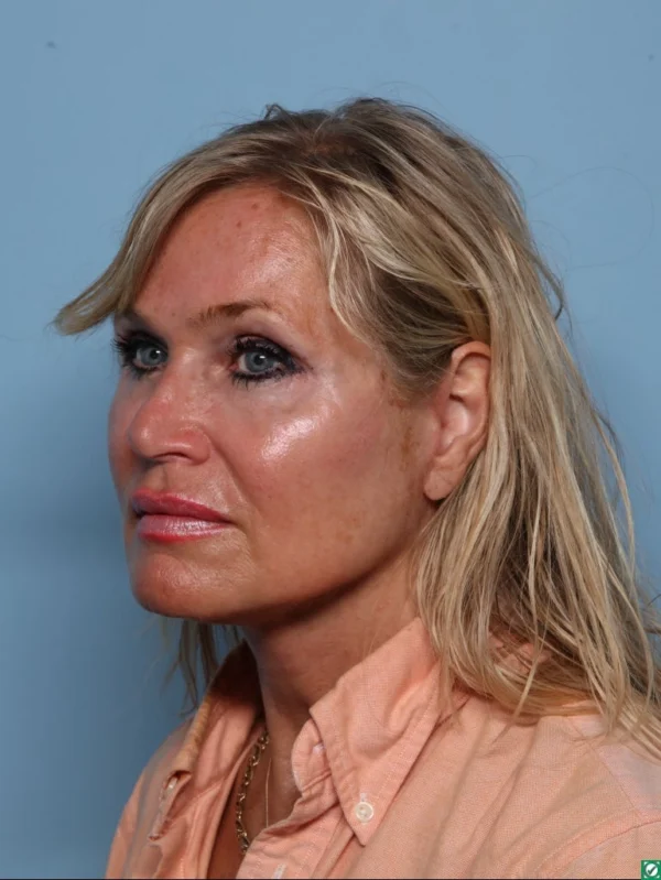 Facelift