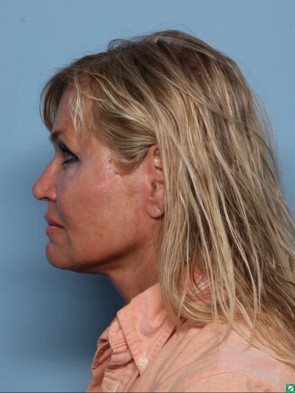 Facelift