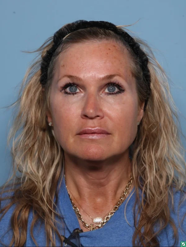 Facelift