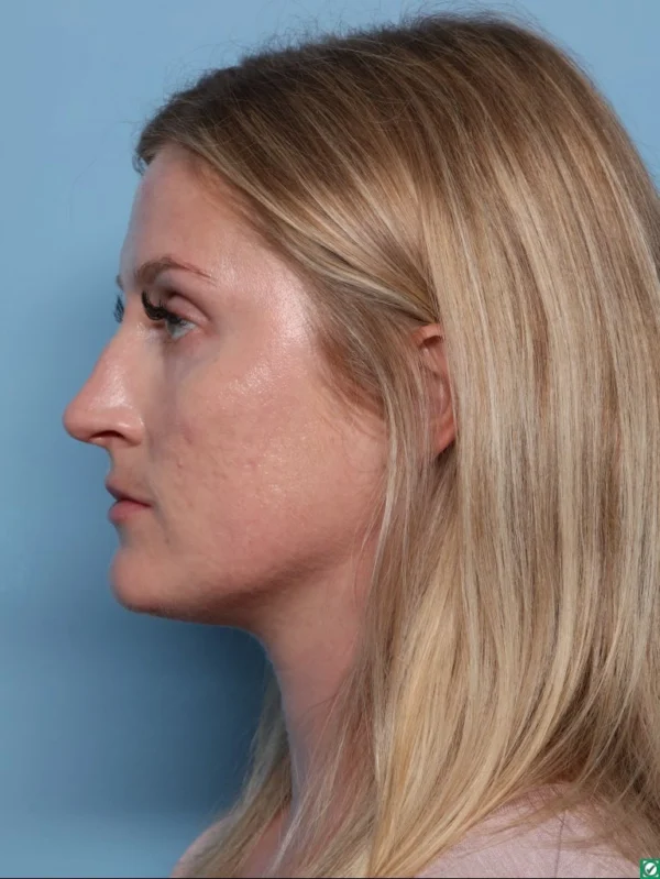 Rhinoplasty