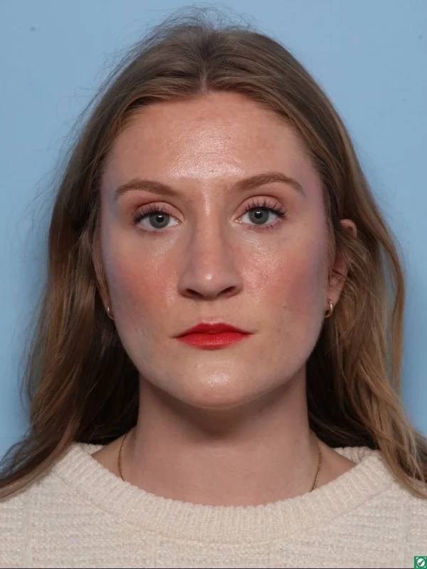 Rhinoplasty
