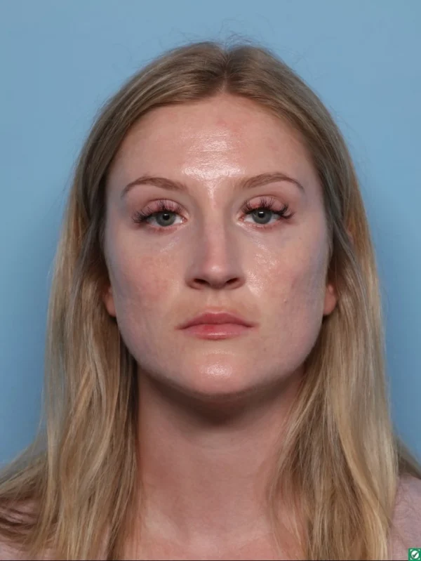 Rhinoplasty