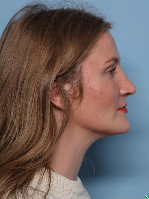 Rhinoplasty