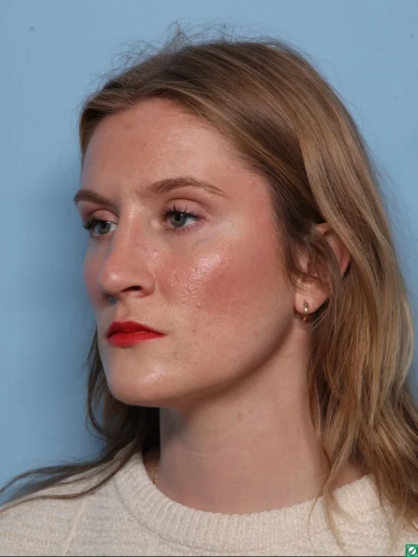 Rhinoplasty