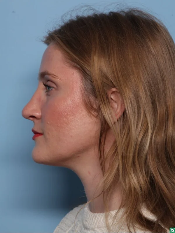 Rhinoplasty