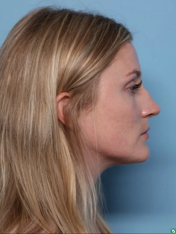 Rhinoplasty