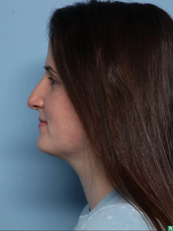 Rhinoplasty