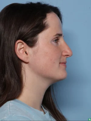 Rhinoplasty