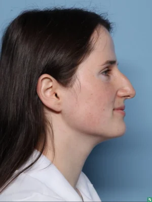 Rhinoplasty