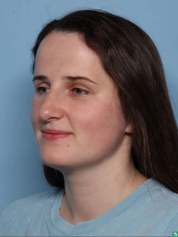 Rhinoplasty