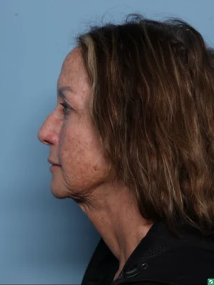 Skin Cancer Reconstruction