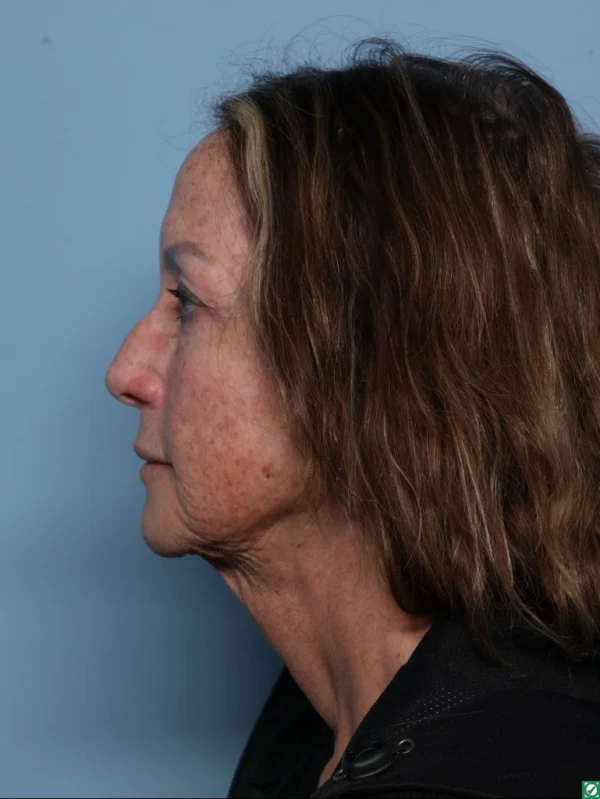 Skin Cancer Reconstruction